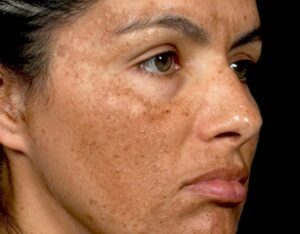 Blog 1 Melasma: Definición, causas y los mejores tratamientos disponibles
