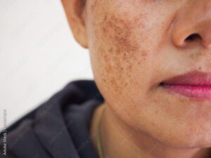 Blog 2 Causas de las manchas de la piel en el rostro