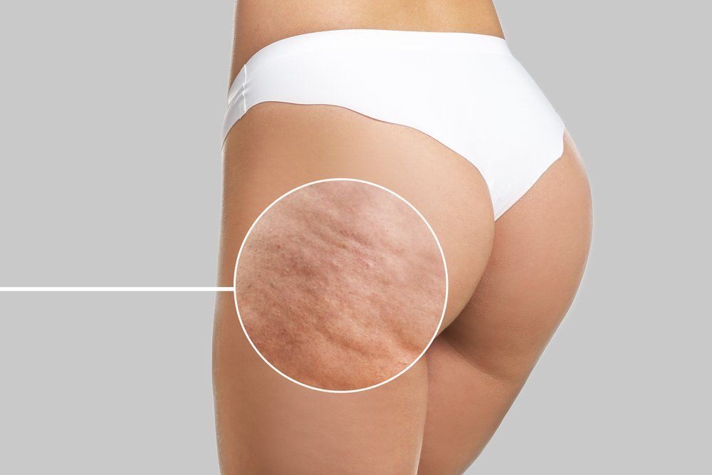 Celulitis: causas reales, tipos y tratamientos no invasivos 1 Skin Care Center - Heredia