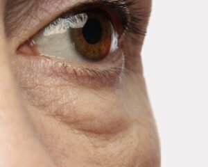 Blog 3 ojeras, causas y tratamiento