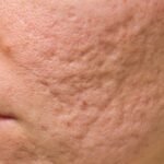 Cicatrices de acné: tipos y opciones para mejorar su apariencia 1 Cicatrices de acné y textura irregular en la piel del rostro