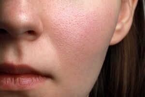 Inicio 11 Primer plano de piel facial con poros dilatados visibles