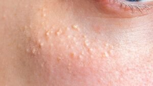 Inicio 11 Primer plano del rostro con pequeños quistes de milium alrededor de los ojos